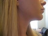 I also have a deep sulcus from the implant that I am hoping can be lessened through sliding genio.