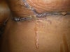 right breast leakage from middle to bottom incision