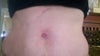upper area, accidental puncture while fixing small umbilical hernia