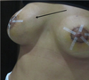 In the pic you can't see the ripple so much but you can feel the implant very much, it almost feel like a whole