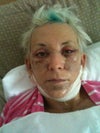 Day 4 post surgery
