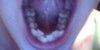 Bottom teeth