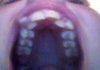 Top teeth