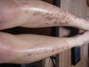 My legs burnt after day 1 of treatment