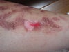 My skin started to peel off after the blister popped.