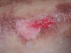 Close up of the wound.