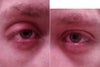 Notice the shape of medial corner of both eyes; perhaps requires better support?