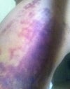 Bruising on thigh from Smart Lipo. Both look the same.
