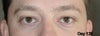 120 days. Eyelashes pretty well back, but a lumpy lid issue. Still waiting for little improvements.