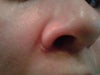 Bumpy scar on right nostril