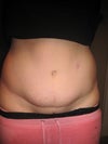 1 year post op