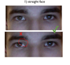 eye A is the 'bad' eye shape that I want fixed with surgery to be symmetrical with eye B