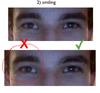 eye A is the 'bad' eye shape that I want fixed with surgery to be symmetrical with eye B
