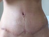 3 weeks post op