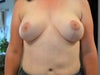 Left has more projection and length and is larger in volume. Hoping to even this out with removal of both implants and a reduction to left and lift to right. Think that this will work?