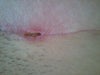 picture of abcess