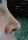 Right view w/crease - This is what I want my left nostril to look like