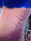 Left hips to ribs bruising