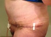 9 days post op