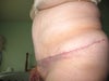 seroma after aspiration of 135 ccs 19 days post op