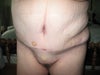 seroma after aspiration, 19 days post op
