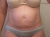 see scars in a circle where mesh put in