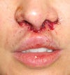 Day of surgery (major trauma, large incision)