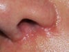 close up of scar