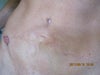 ~View of my tummy tuck~the hard area is where my scar goes up~
