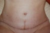 9 weeks post op vertical incision.