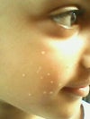 There is pic of my daughter affected from pimple or warts or anything please advise medicine to treat it