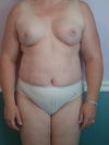 4.5 wks post-op