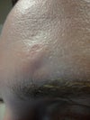 Notice the ruddy bumpy texture to my skin. This is visible everywhere the laser touched.