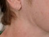 raised ridge along my jaw line about 1 inch in length just below ear