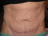 Front View 8 Weeks Post-Op full Abdomioplasty with diastasis and umbilical hernia repair