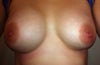Even though the left breast was originally not moving freely in the pocket, the result looked much closer than it is now.