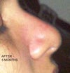 some kind of polly beak after rhinoplasty no present before the procedure.