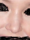 nose after surgery has appearance of hump but there isn't one