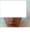 From the front. 7 months after revision rhino. Hard and 'swollen' with a hard, round 'swelling' on the right nostril next to bridge.