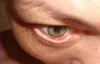 eye pulled away from globe...