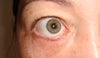 right eye sag and medial corner stretch from stitch.