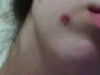 Mole removal - day 2 (has prescribed antibiotic ointment on it)