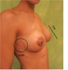 flat over the nipple and visible scars on the side from the drain tubes