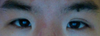 Post Restylane