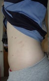 Day five post op