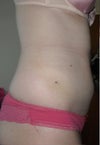 Day seven post op