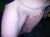 This is where I needed my belly but initial incision must have been made to low to accommodate functionality.