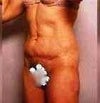 this is how I looked i the front before the lift.  I seem to miss now support from my oblique area and from the arch I use to have over the top of my front leg.