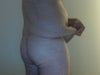 Pulling Abdominal Skin Out