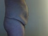 Abdominal Skin At Rest